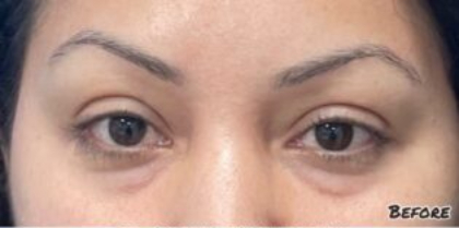 Xeomin Before & After Patient #603