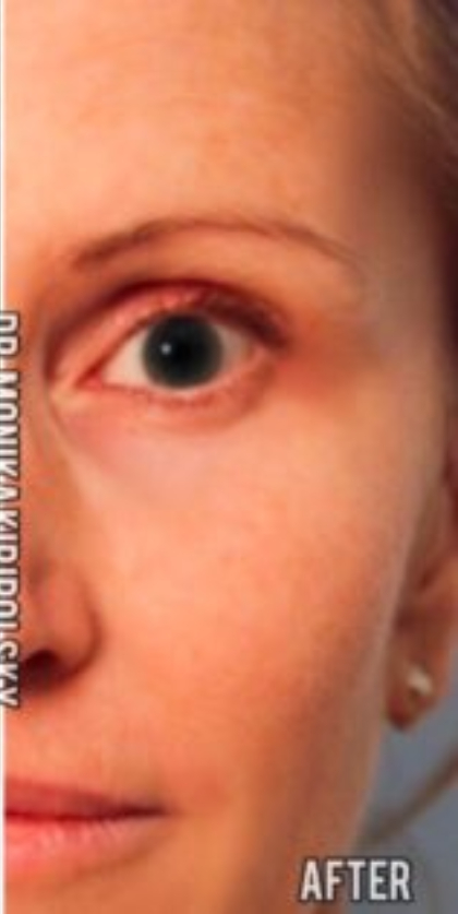 Xeomin Before & After Patient #604