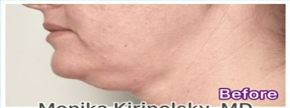 Kybella Before & After Patient #643