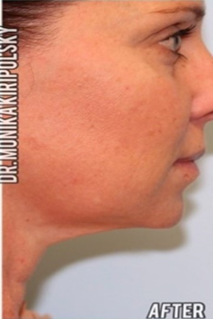 Kybella Before & After Patient #644