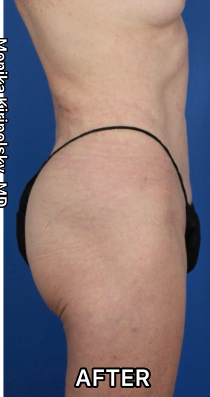 Tumescent Liposuction Before & After Patient #675