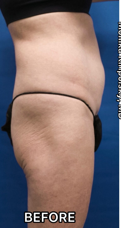 Tumescent Liposuction Before & After Patient #675