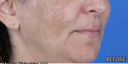 Melasma Before & After Patient #651