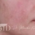 Acne Scarring Before & After Patient #619