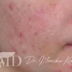 Acne Scarring Before & After Patient #619