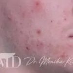 Acne Scarring Before & After Patient #620