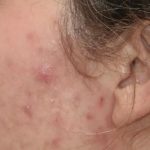 Acne Scarring Before & After Patient #621