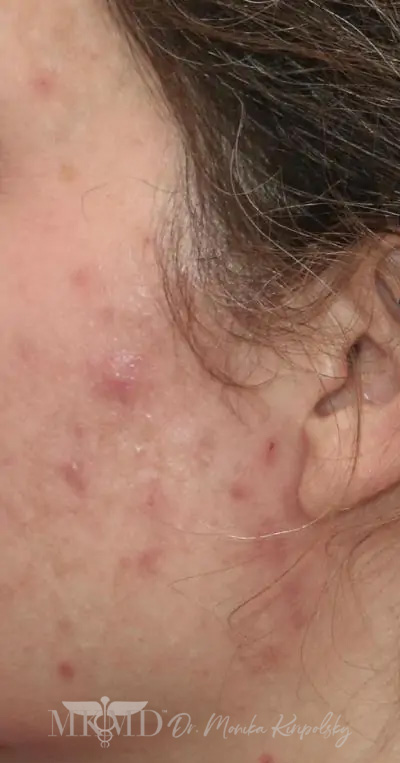 Acne Scarring Before & After Patient #621