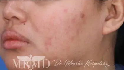 Acne Scarring Before & After Patient #623