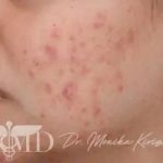 Acne Scarring Before & After Patient #623