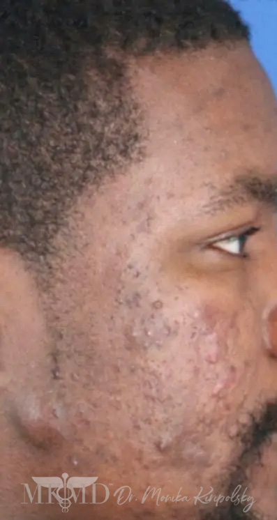 Acne Scarring Before & After Patient #624