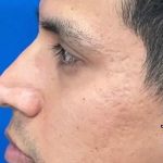 Acne Scarring Before & After Patient #637
