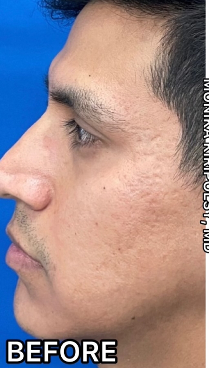 Acne Scarring Before & After Patient #637