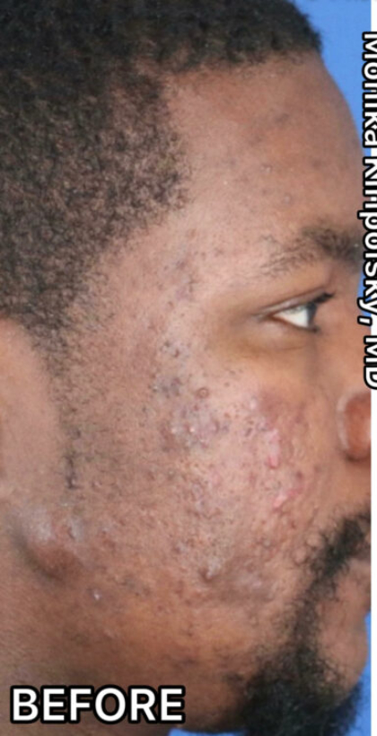 Acne Before & After Patient #624