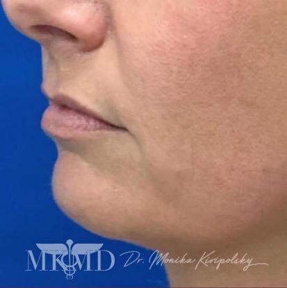 Juvederm Before & After Patient #533