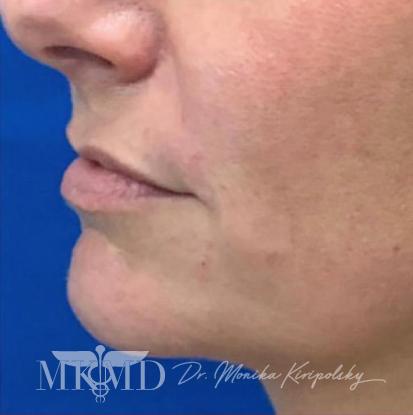 Juvederm Before & After Patient #533