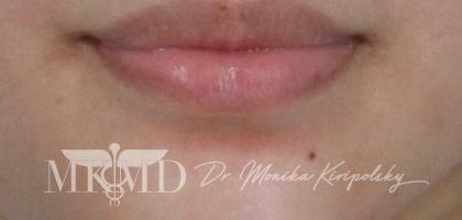 Juvederm Before & After Patient #536