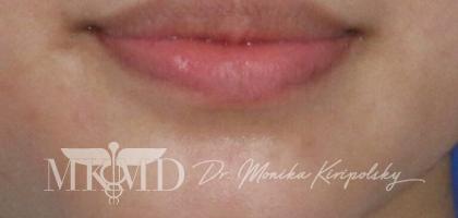 Juvederm Before & After Patient #536