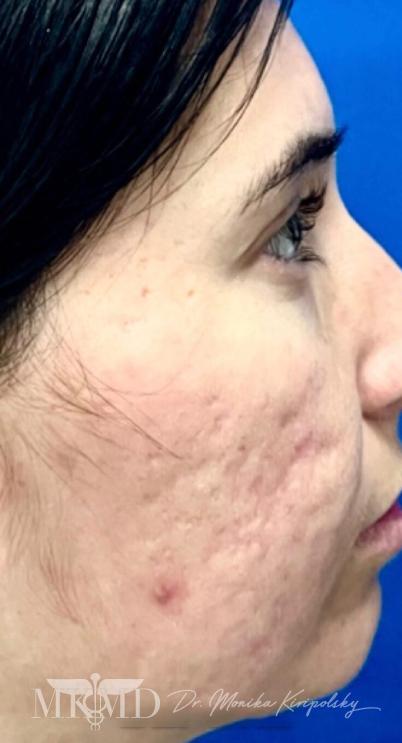 Acne Scarring Before & After Patient #638