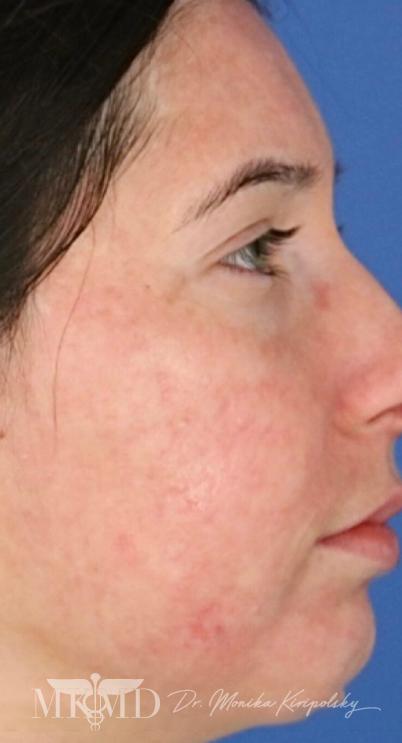 Acne Scarring Before & After Patient #638
