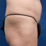 Liposuction / Liposculpture Before & After Patient #675