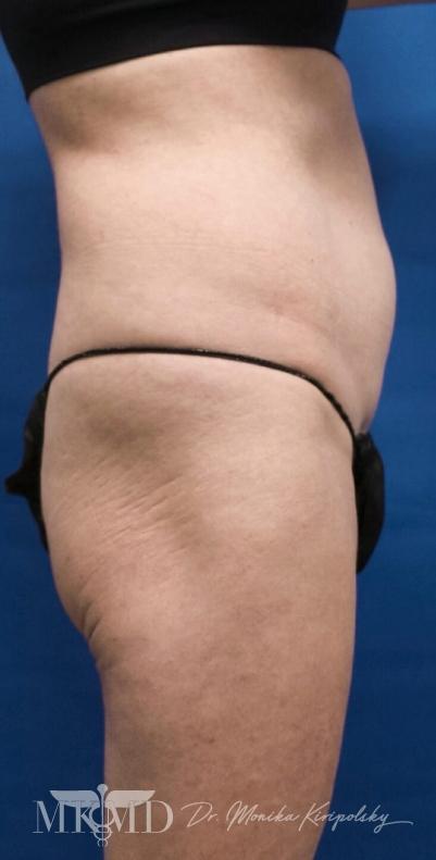 Liposuction / Liposculpture Before & After Patient #675