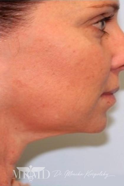 Kybella Before & After Patient #644