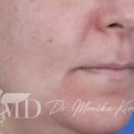 Melasma Before & After Patient #651