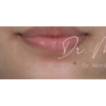 Mole & Melanoma Removal Before & After Patient #536
