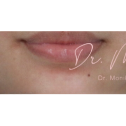 Mole & Melanoma Removal Before & After Patient #536