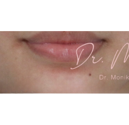 Mole & Melanoma Removal Before & After Patient #536