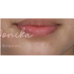 Mole & Melanoma Removal Before & After Patient #536