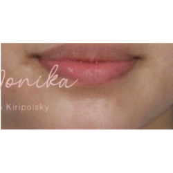 Mole & Melanoma Removal Before & After Patient #536
