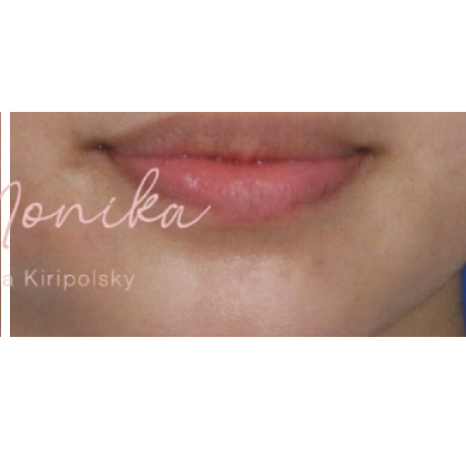 Mole & Melanoma Removal Before & After Patient #536