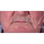 Dysport Before & After Patient #542