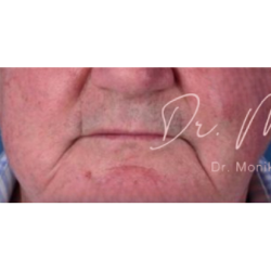 Dysport Before & After Patient #542