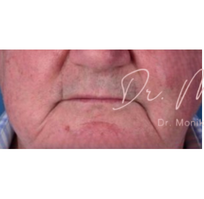 Dysport Before & After Patient #542