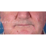 Dysport Before & After Patient #542