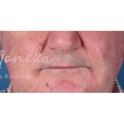 Dysport Before & After Patient #542