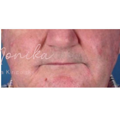 Dysport Before & After Patient #542