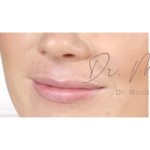 Lip Filler Before & After Patient #558