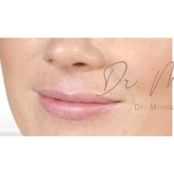 Lip Filler Before & After Patient #558