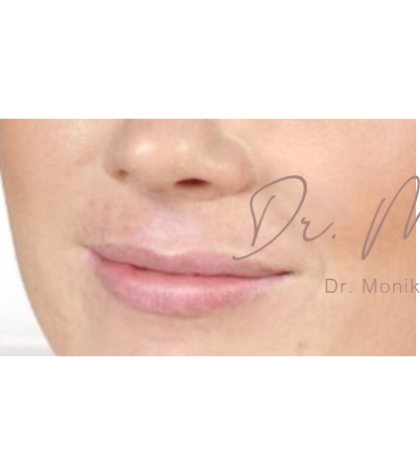Lip Filler Before & After Patient #558