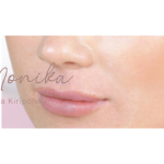Lip Filler Before & After Patient #558