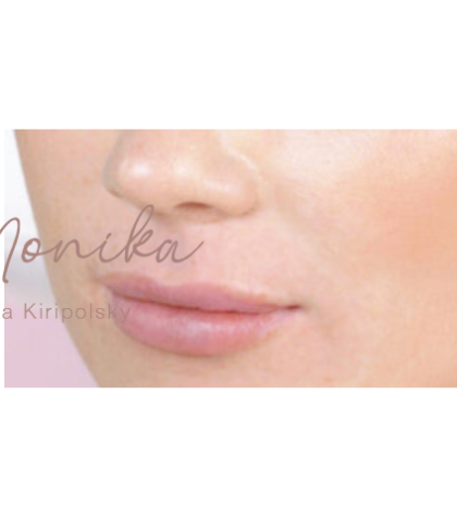Lip Filler Before & After Patient #558