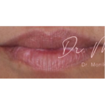Lip Filler Before & After Patient #560