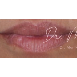 Lip Filler Before & After Patient #560