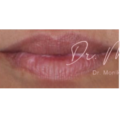 Lip Filler Before & After Patient #560