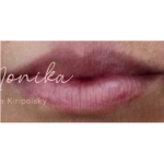 Lip Filler Before & After Patient #560