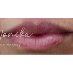 Lip Filler Before & After Patient #560